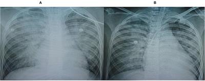 Case Report: Successful Treatment of a Child With COVID-19 Reinfection-Induced Fulminant Myocarditis by Cytokine-Adsorbing oXiris® Hemofilter Continuous Veno-Venous Hemofiltration and Extracorporeal Membrane Oxygenation